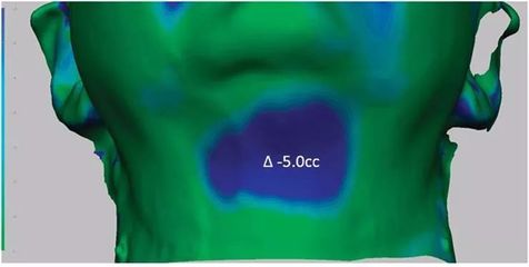 3D成像評估注射溶脂/冷凍溶脂后頦下脂肪消除情況